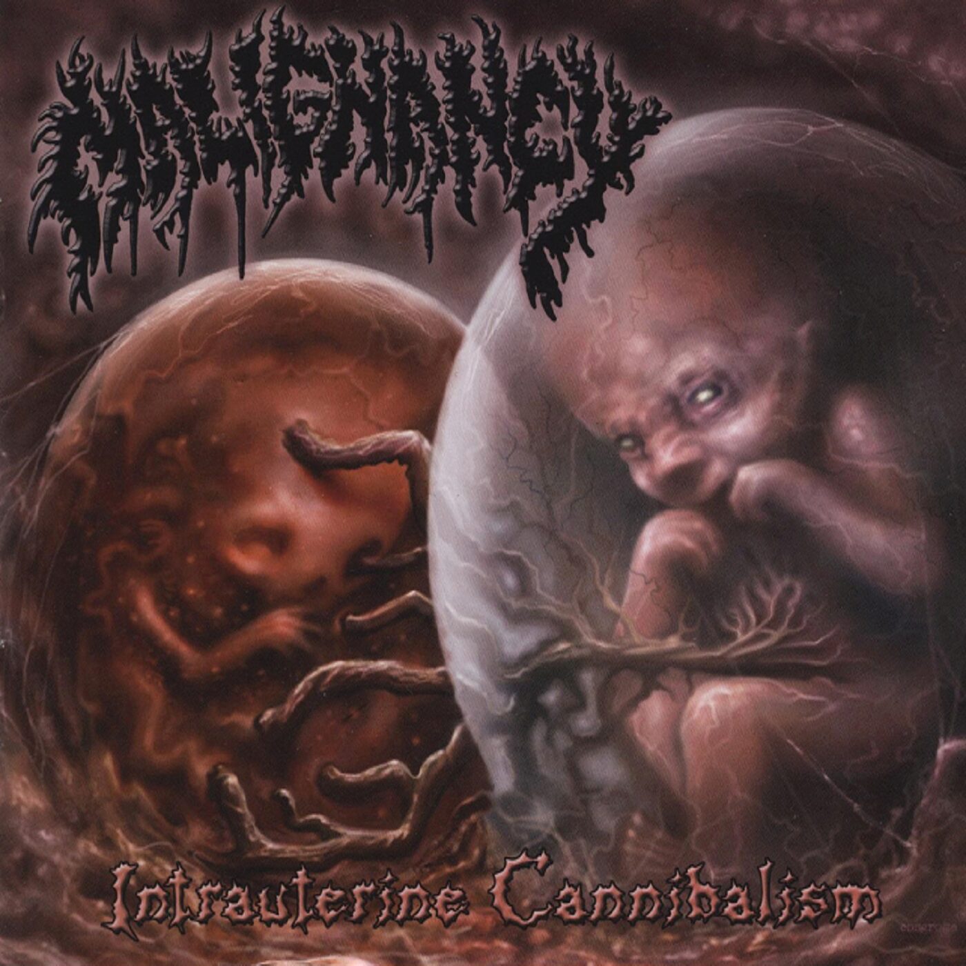 Malignancy - Intrauterine Cannibalism (2 CD Set) Malignancy - Intrauterine Cannibalism (2 CD Set)