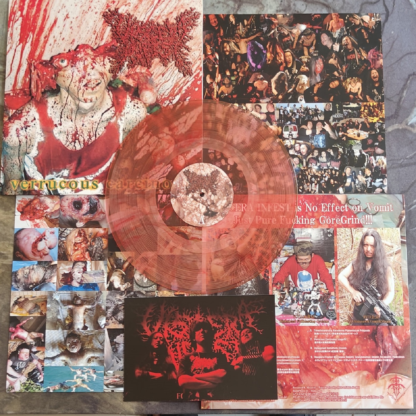 Viscera Infest - Verrucous Carcinoma (LP) Viscera Infest - Verrucous Carcinoma (LP)