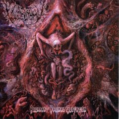 Vulvectomy - Aberrant Vaginal Gestation