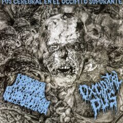Cerebral Suppuration / Oxcipital - Pus Cerebral En El Occipito Supurante Cerebral Suppuration / Oxcipital - Pus Cerebral En El Occipito Supurante