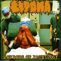 Lipoma - Horrors of Pathology